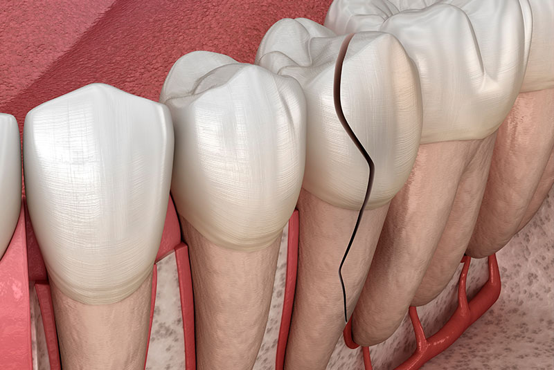 close up cracked teeth