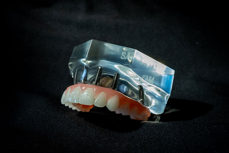 close up of dental implant arch model within the dental center